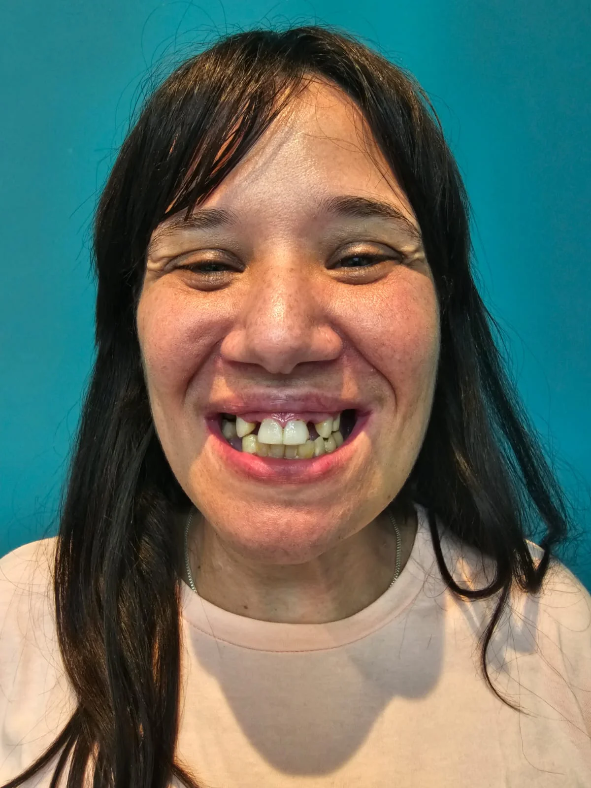 Antes y después de coronas de porcelana en dientes frontales Antes