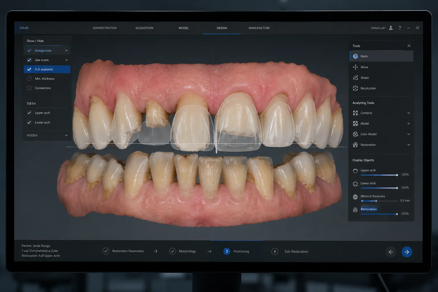 Comparación entre simulación digital 3D y resultado real del implante Antes